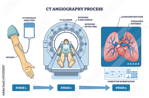 CT angiography process shows IV contrast injection, CT scanner, and 3D artery visualization, illustrating blood vessel imaging steps. Outline diagram