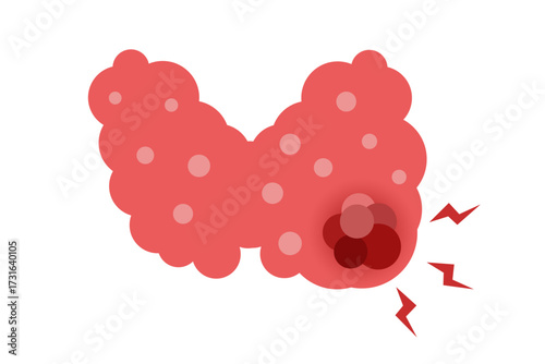 thyroid disease concept. vector illustration