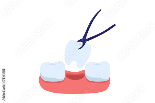 Illustration of Tooth Extraction Procedure. Forceps Removing a Tooth, a Concept of Dental Surgery and Oral Treatment