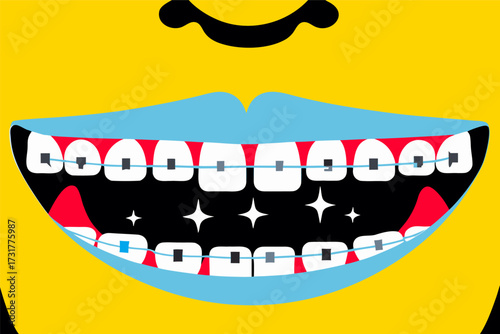 Smiling Mouth Vector Illustration with Dental Braces on Clean Teeth, Healthcare Concept.