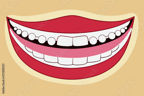 Vector Illustration of a Happy Smiling Mouth with Orthodontic Braces and Healthy Teeth
