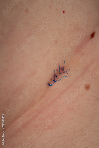 Stitches After Nevus Removal Surgery