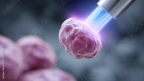 Medical laser lithotripsy modern therapy for kidney stone disease. This advanced treatment shows hopeful concept in urology for breaking painful calculus