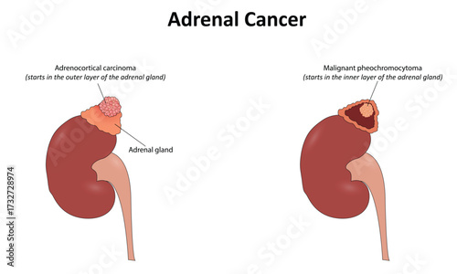 Adrenal cancer vector illustration