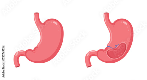 Healthy Stomach and Stomach with Ulcer Medical Illustration of Digestive System