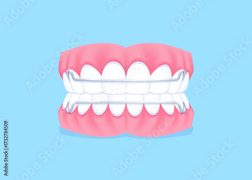 Full mouth teeth - Hawley retainer illustration vector design. Dental care concept.