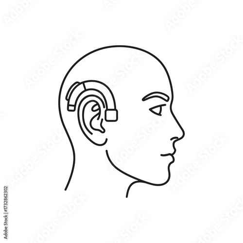 Cochlear implant illustration displays modern hearing aid device on human head, ear model. Hearing aid implantation improves hearing ability and sound perception.