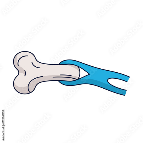 Bone fracture illustration showing bone being mended with surgical equipment. Bone fracture repair requires specialized tools to align bones for healing.