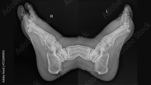 Bilateral foot X-ray showing symmetrical lateral views 