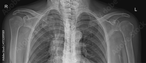 Left and Right Shoulder Joint AP Views 