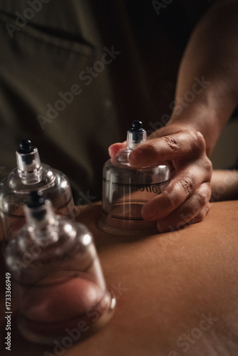 Close up cupping massage therapy treatment