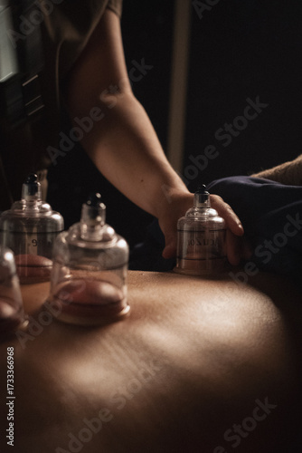 Close up cupping massage therapy treatment