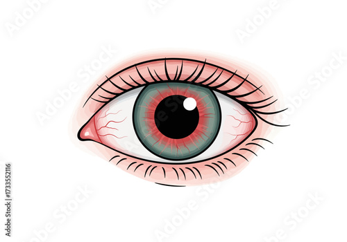 Illustration of a Red and Irritated Human Eye.