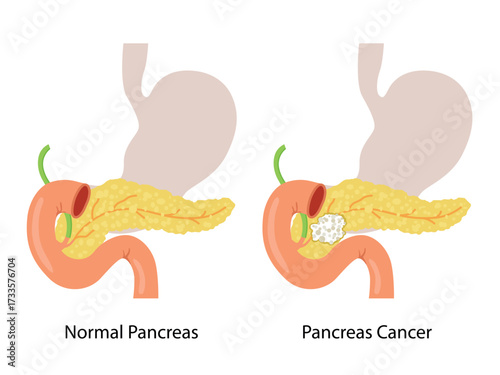 Pancreas or Pancreatic Cancer with organs and Tumors. Cancerous cells for education material, brochure, website, medical portal, atlas, textbook, presentation. Oncology, disease, medical, healthcare c
