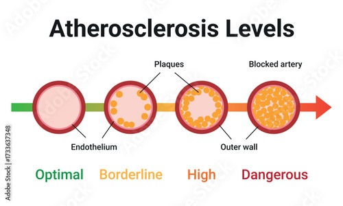 Atherosclerosis Level. Type of cholesterol in human blood vessels. Normal artery, blocked vascular, fatty streak, plaque, Moderate. Medical Vector illustration.