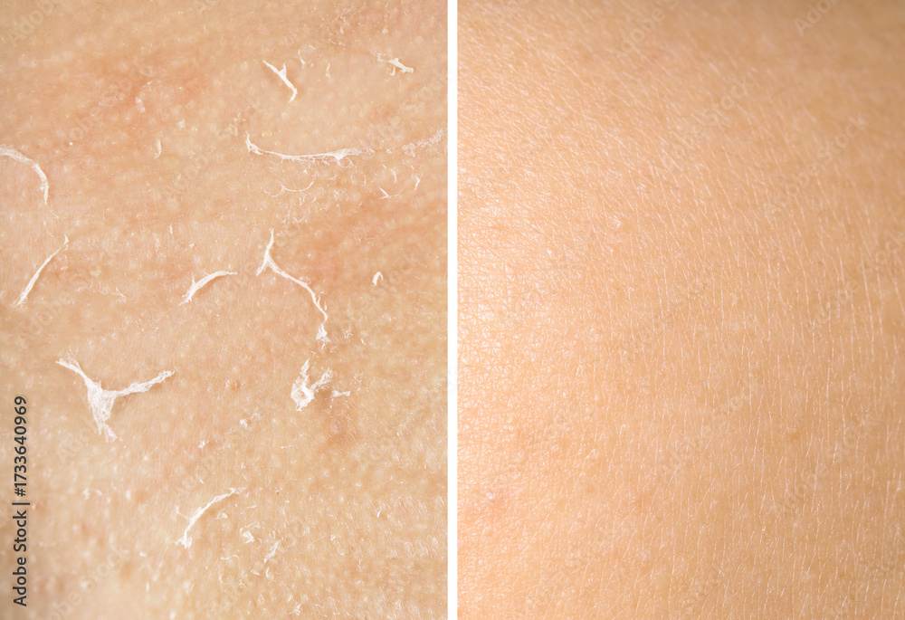 Fototapeta premium Dry skin on one side and moisturized on another, collage before and after