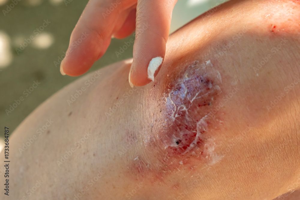 Fototapeta premium Injury on skin showing healing wound on elbow in sunny outdoor setting during summer afternoon