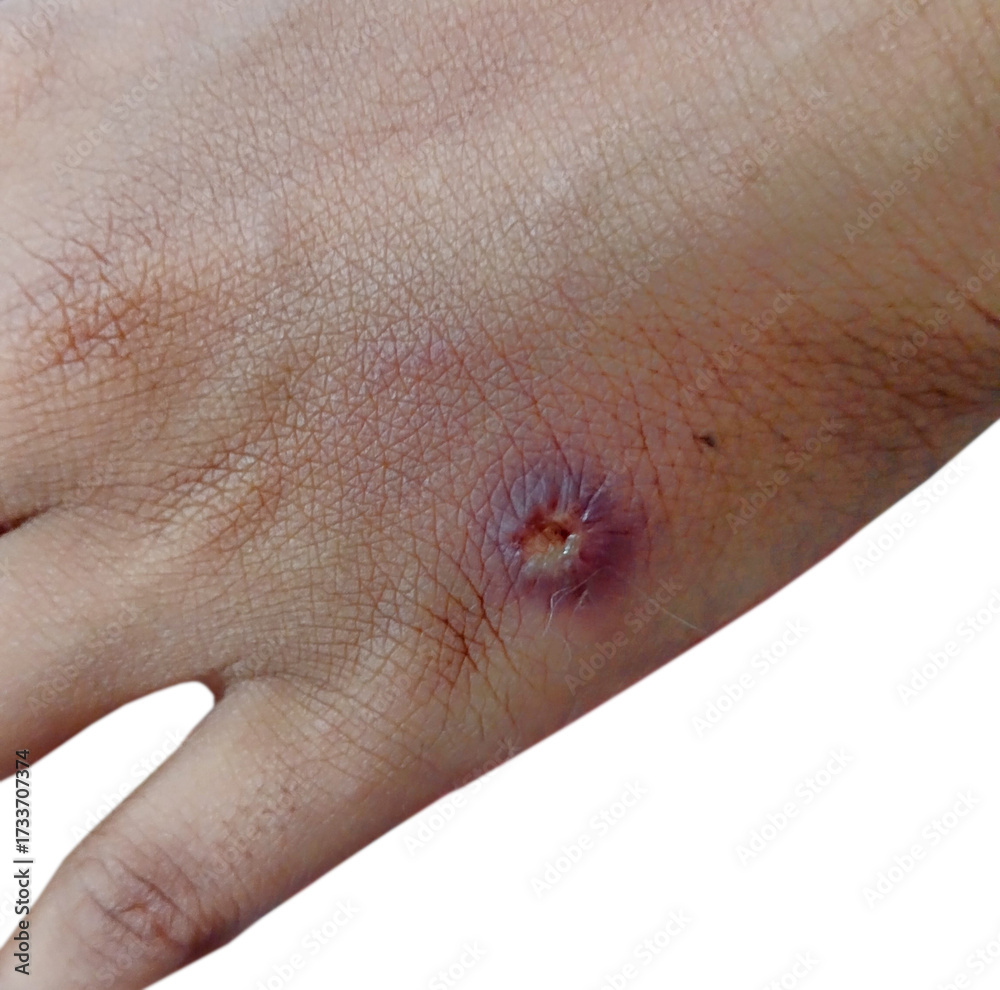 Fototapeta premium Wounded Hand with Bruising and Healing Signs Visible