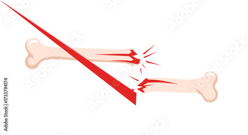Diagram illustrating a broken bone with a sharp impact causing the fracture.