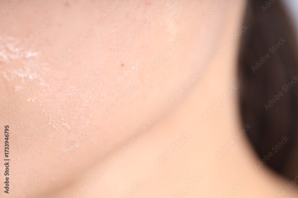 Fototapeta premium Woman with dry skin on her face, closeup