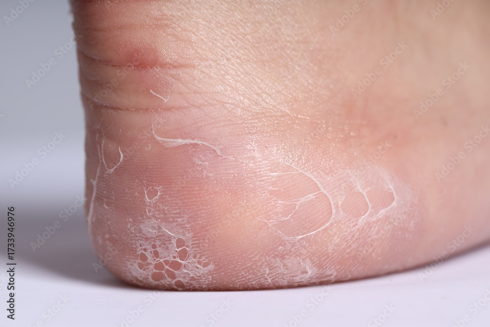 Fototapeta premium Woman with dry skin on her foot against light background, closeup
