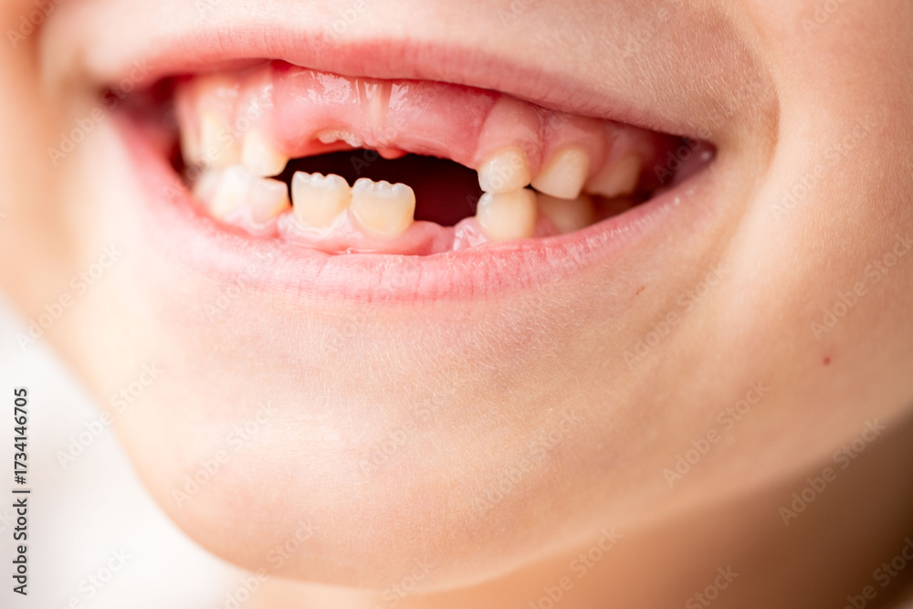 Obraz premium happy positive caucasian funny toothless 6-year-old girl, child baby tooth, smiling childhood moment waiting for toothfairy, growing up, cute Toothless smile expression, innocence and joy childhood