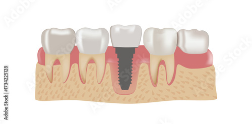 Dental Implant Illustration Healthy Teeth Gum and Bone Structure for Dental Health Care and Cosmetic Procedures Diagram