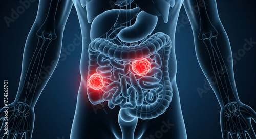 Human body digestive system with inflamed colon and intestine highlighting cancer and disease process