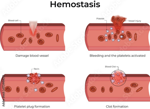 Hemostasis, Blood Vessel Injury, Platelet Plug Formation, and Coagulation Vector Illustration.