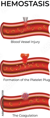 Hemostasis, Blood Vessel Injury, Platelet Plug Formation, and Coagulation Vector Illustration.