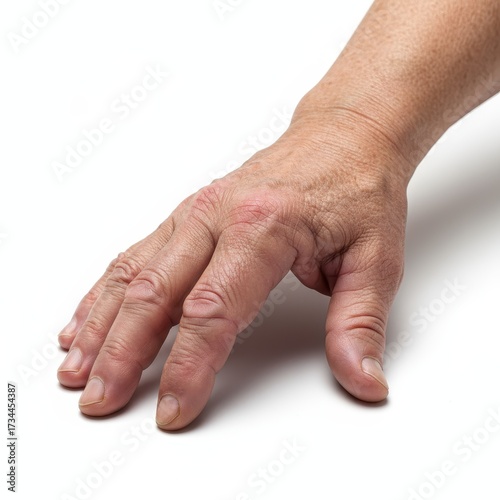 Arm with swelling due to arthritis