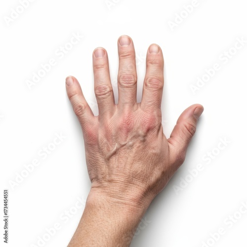 Arm with swelling due to arthritis