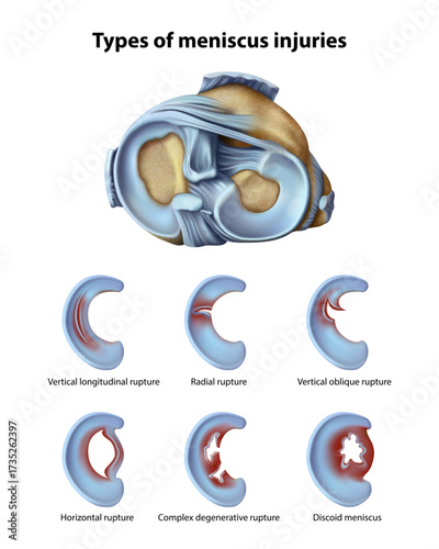 Meniscus damage. Isolated vector illustration.