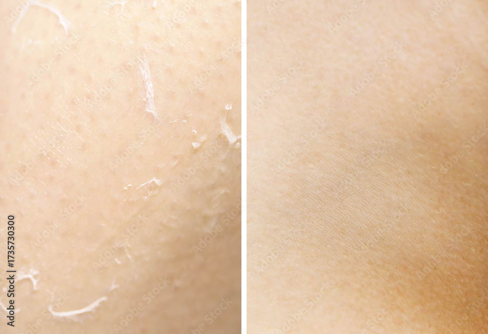 Fototapeta premium Dry skin on one side and moisturized on another, collage before and after