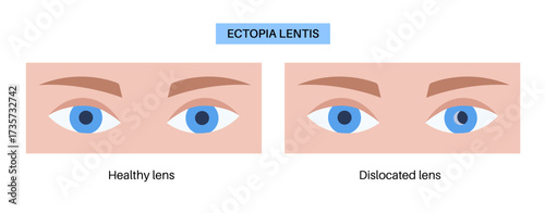 Ectopia lentis disease