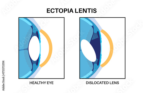 Ectopia lentis disease