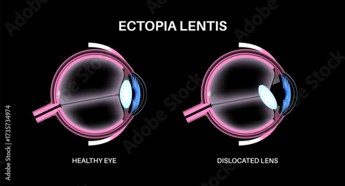 Ectopia lentis disease