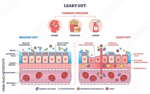 Leaky gut diagram shows healthy vs damaged gut lining, highlighting epithelial cells, tight junctions, and triggers. Outline diagram