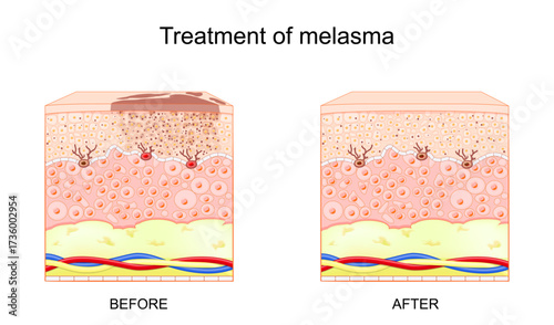 Melasma treatment. Management of Melasma. Hloasma faciei.