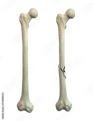 Femur bone with shaft fracture, 3D illustration