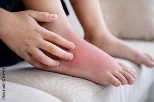 Asian boy scratching his feet with redness and itching caused by an insect bite. Close-up view of a child’s leg showing skin rash, red spots, and allergic reaction to insect.