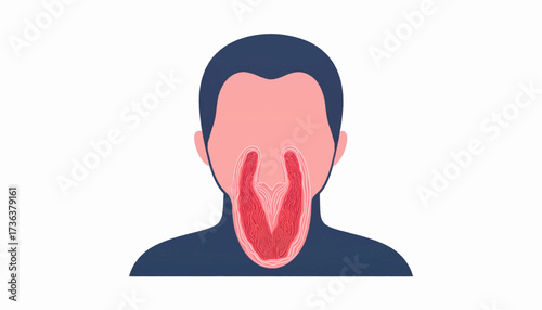 A medical illustration of a person with a sore throat, showing red inflammation in the pharynx and tonsils.