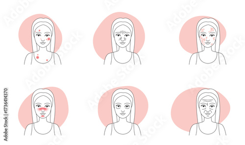 Skin problems line icons set vector illustration. Outline sketches of women with wrinkles and melasma, pimple infection and oily blackhead pore, rosacea on girls face in infographic collection