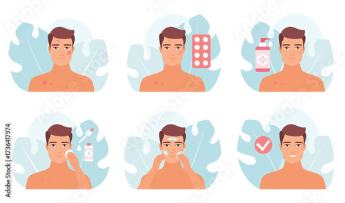 Acne treatment infographic vector illustration set. Cartoon man cleansing skin, whitening comedo and pimple with cosmetic lotion, male models apply beauty product on face to care and treat pimply skin