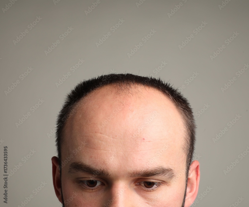 Fototapeta premium Baldness problem. Man with receding hairline on grey background, closeup