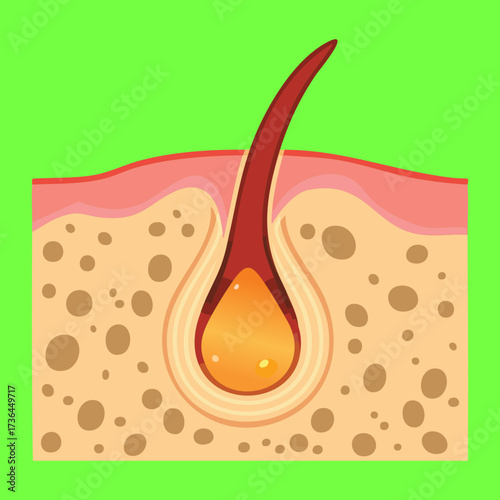 Medical cross-section showing a single inflamed hair follicle with a swollen bulb and excessive oil production or infection