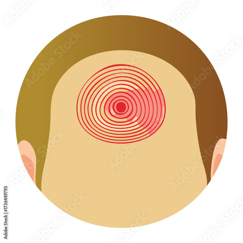 Conceptual illustration of headache or scalp pain depicted with concentric red circles radiating from a central spot on the head