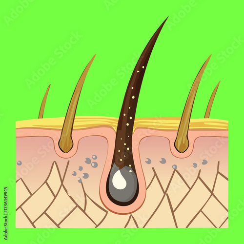 Cross-Section of Skin Showing Hair Follicles with Damage to the Shaft and Surrounding Tissue, Illustrating Hair Damage	