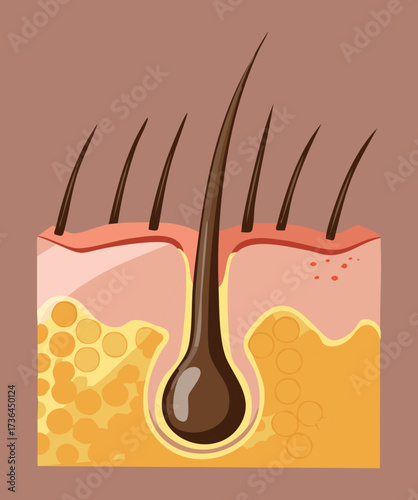 Hair Follicle Blocked by Excess Sebum or Oil Production, Illustrating the Cause of Acne, Dandruff, or Seborrheic Dermatitis	