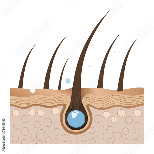 Diagram of Hair Follicle Affected by Pustule or Cyst Formation, Indicating Acne, Dermatitis, or other Skin Ailments	